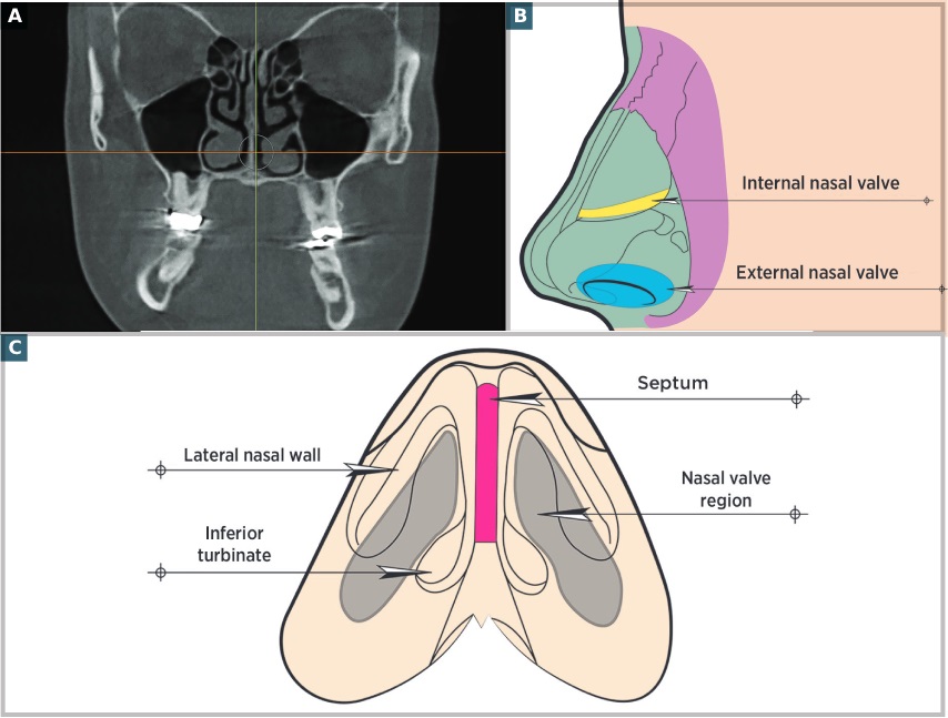 Nasal Airway Obstruction And Orofacial Pain